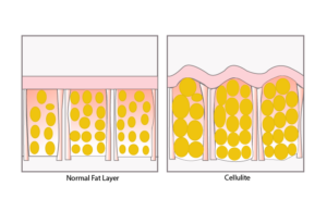 cellulite infographic