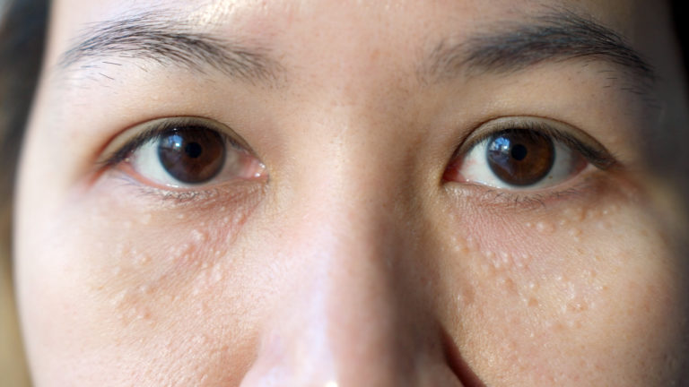 Syringomas under the eyes