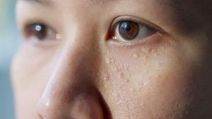 Syringomas under the eyes