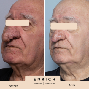 Rhinophyma-1-300x300