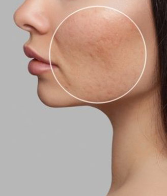 acne scarring