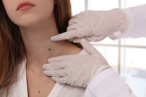 melanoma biopsy dermatologist melanoma