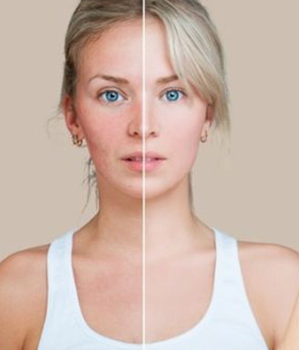 controlling the flushing of rosacea