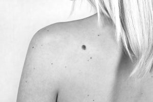 how is melanoma diagnosed melanoma mole
