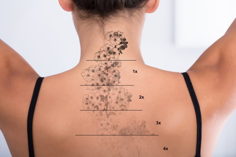 tattoo removal