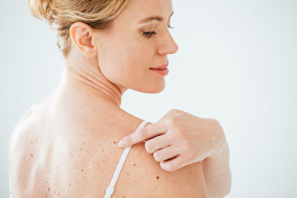 skin cancer check