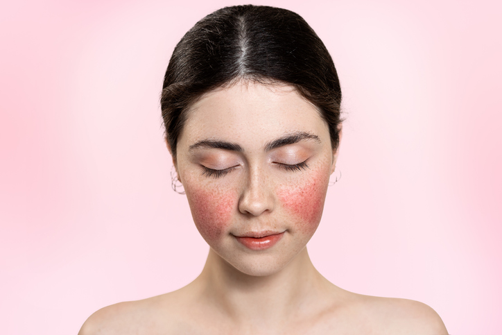 broken blood vessels