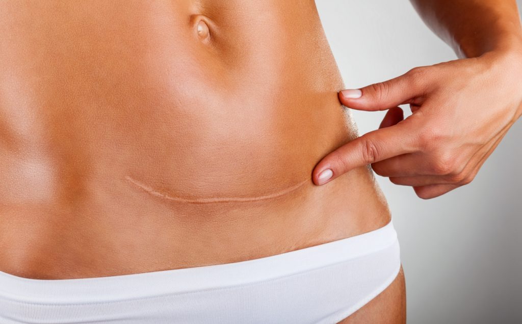 laser scar treatment melbourne