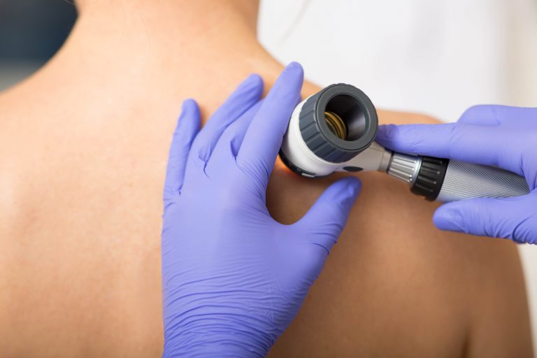 skin check melanoma