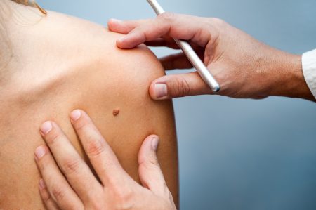 Understanding non-melanoma skin cancer