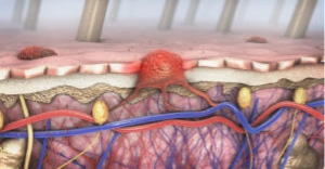 how does skin cancer start, skin check in melbourne