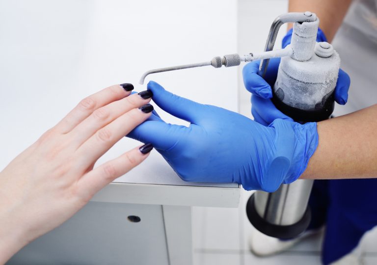nitrogen to remove warts
