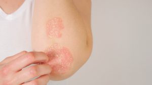 psoriasis on elbow