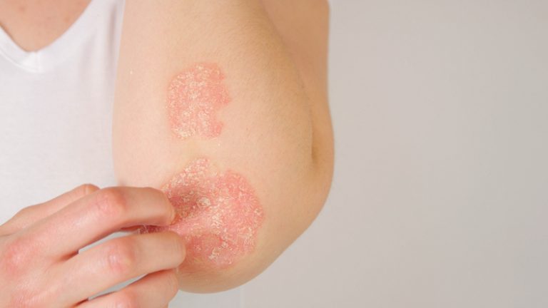 psoriasis melbourne