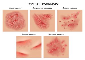 types of psoriasis infographic
