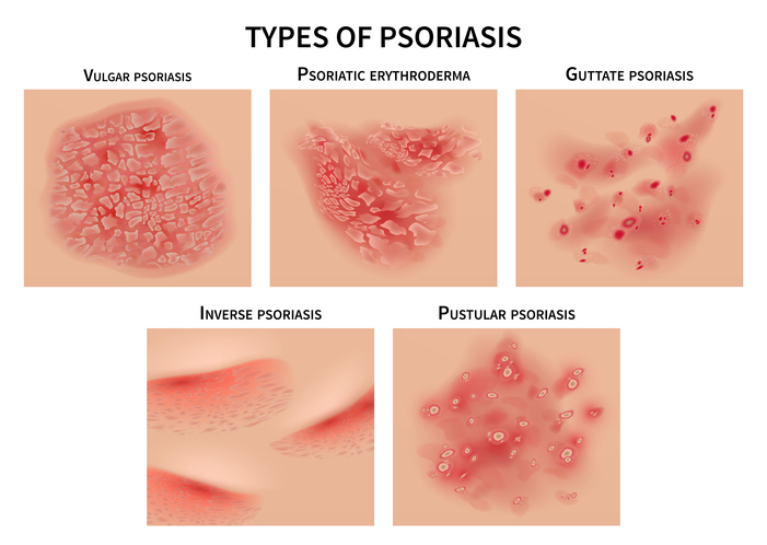 types of psoriasis info graphic