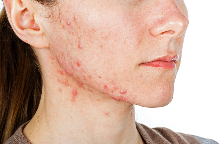 adult acne