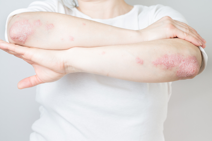 Acute psoriasis on elbows