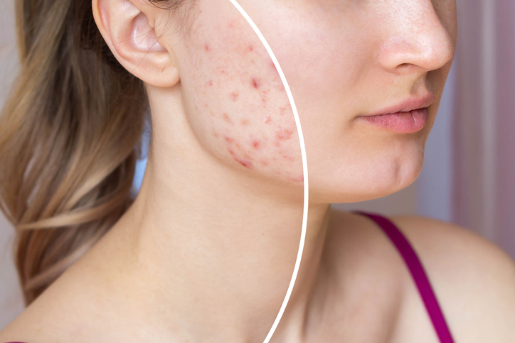 before and after acne treatment