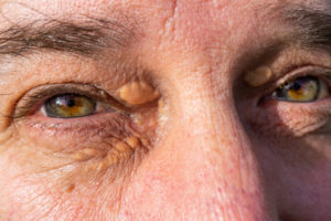 person with xanthelasma