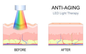 illustration of before and after LED light therapy treatment