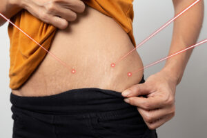 Laser removal treatment of stretch marks