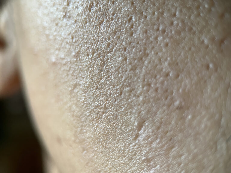 bumps on oily face