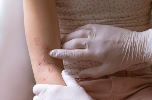 Doctor's hands examining eczema