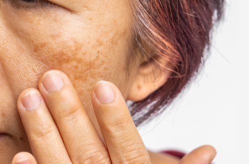 Menopausal women worry about melasma on face.