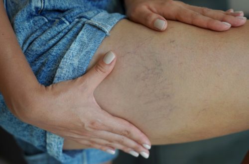 Spider veins on female leg