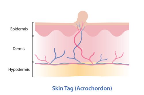 Infographic of skin tag vector illustration.